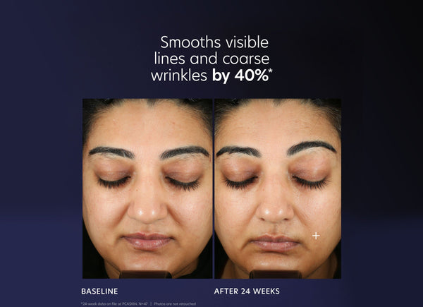 ProMax Age Renewal | PCA Skin