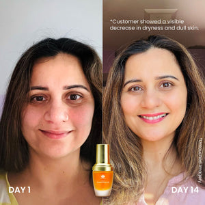Before and after comparison of a woman’s face showing improvement in skin hydration and brightness after 14 days using Timeless Kumkumadi Oil | Shankara, with visible reduction in dryness and dullness.