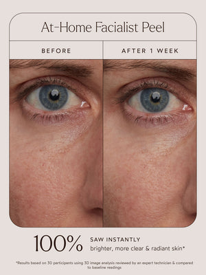 Close-up comparison of a person's skin near the eye area before and after one week of using At-Home Facialist Peel | True Botanicals, showing visibly clearer and more radiant skin.