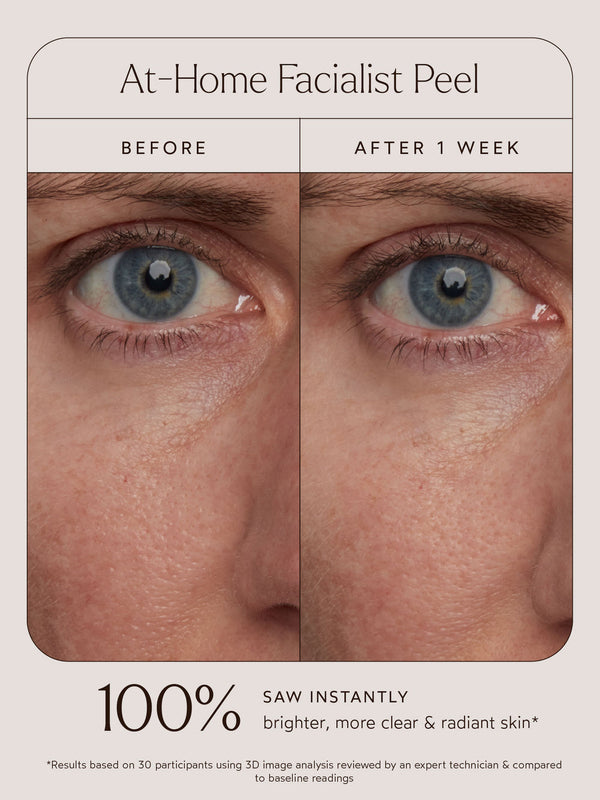 Close-up comparison of a person's skin near the eye area before and after one week of using At-Home Facialist Peel | True Botanicals, showing visibly clearer and more radiant skin.