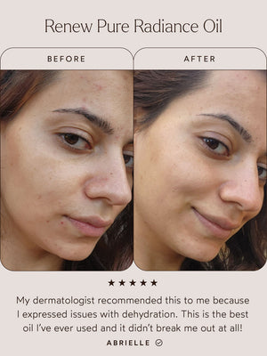 Before and after close-up of a woman's face showing improved skin clarity and hydration using Renew Pure Radiance Oil | True Botanicals, highlighting natural skincare results.