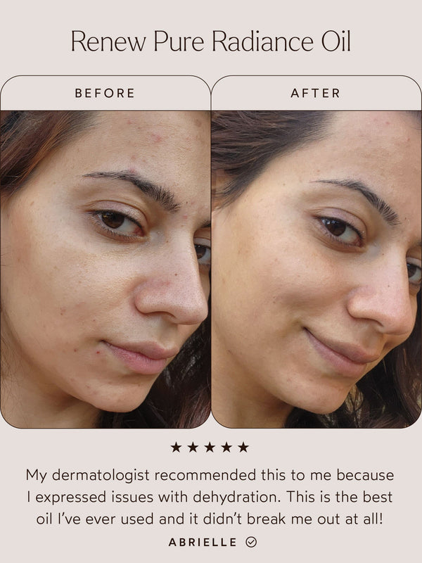 Before and after close-up of a woman's face showing improved skin clarity and hydration using Renew Pure Radiance Oil | True Botanicals, highlighting natural skincare results.