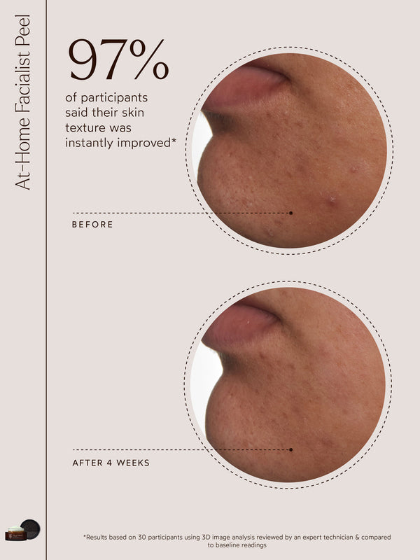 Before and after close-up of skin texture on a person's jawline showing improvement after four weeks using At-Home Facialist Peel | True Botanicals, highlighting clearer and smoother skin.