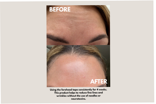 Forehead Tape – Wrinkle Smoothing Patches | Seald™ Wellness