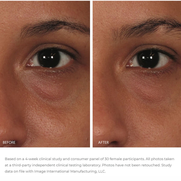 Close-up comparison of a person's eye area showing visible reduction in puffiness and smoother skin after using ORMEDIC balancing eye lift gel | IMAGE Skincare, skincare results.